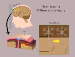 3 Tip Sederhana untuk Mencegah Diffuse Axonal Injury